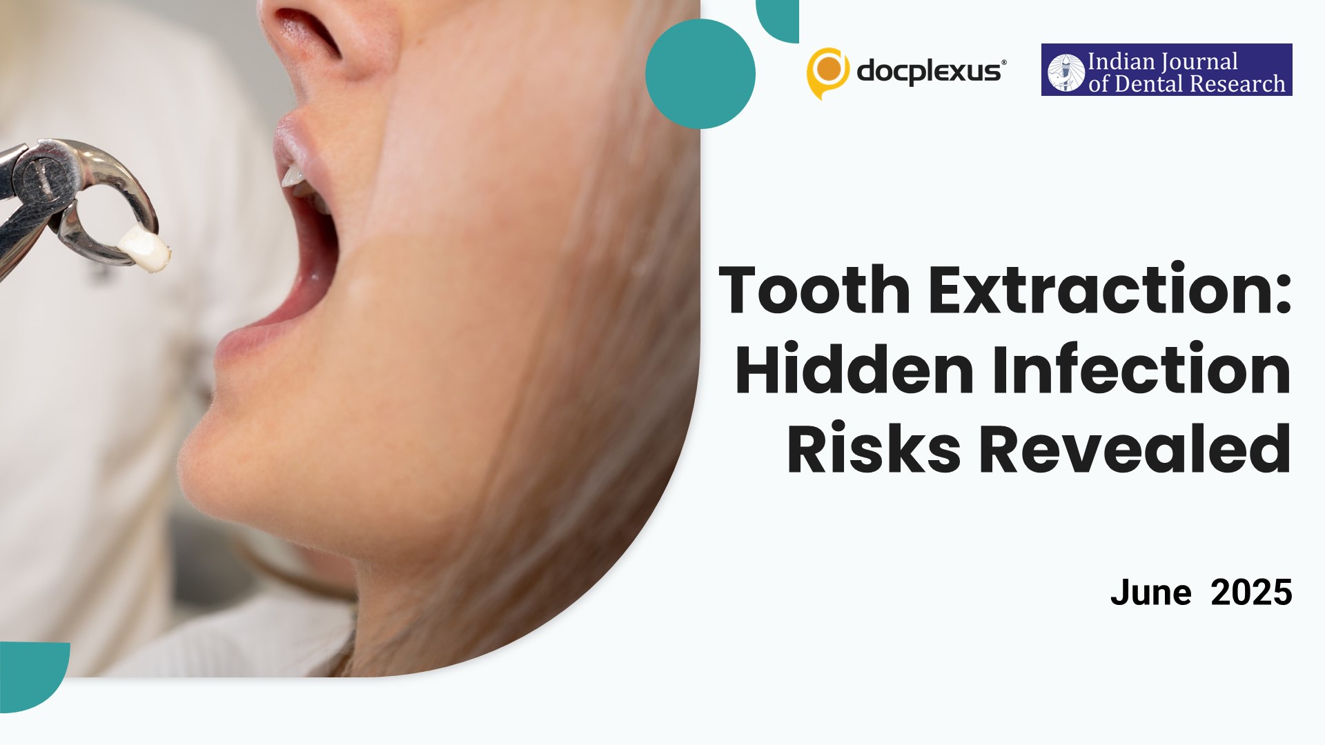 Is Your Tooth Extraction Putting You at Risk? Unveiling Hidden Infections!
