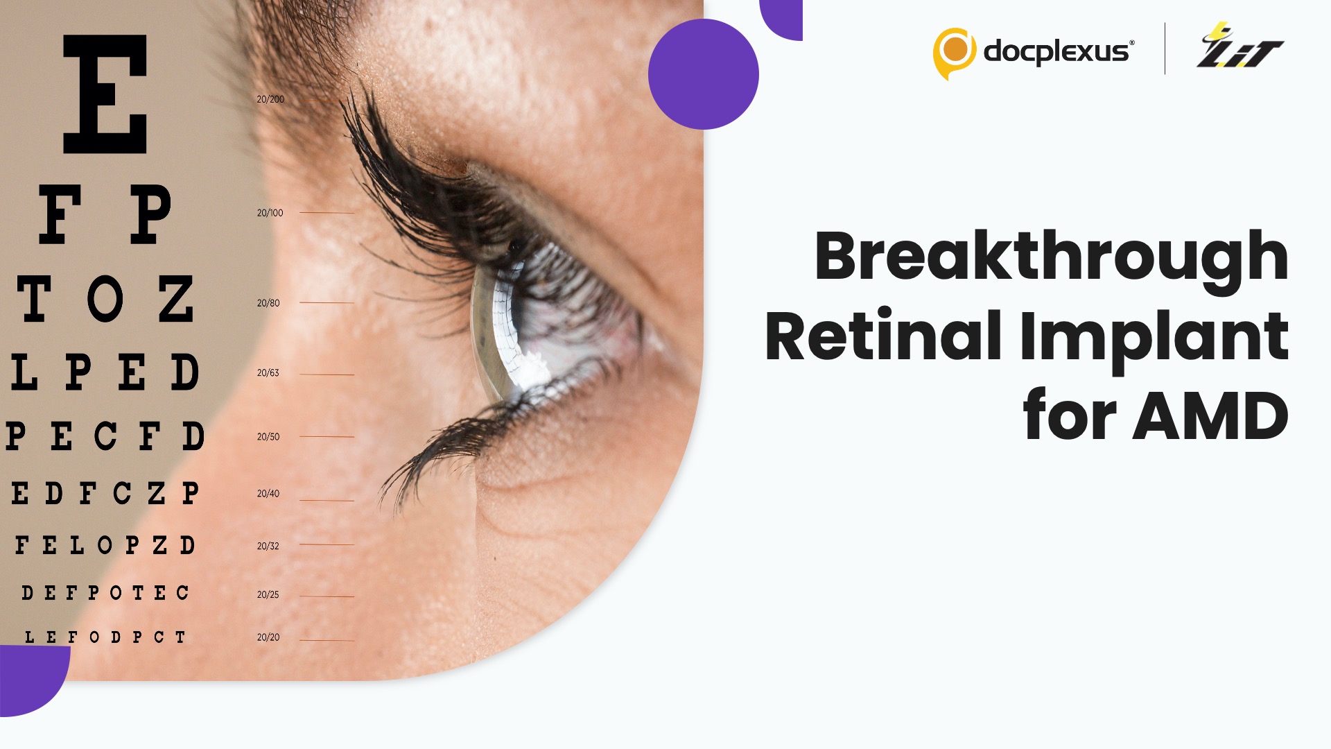 Photovoltaic Implant Revives Central Vision in AMD Patients