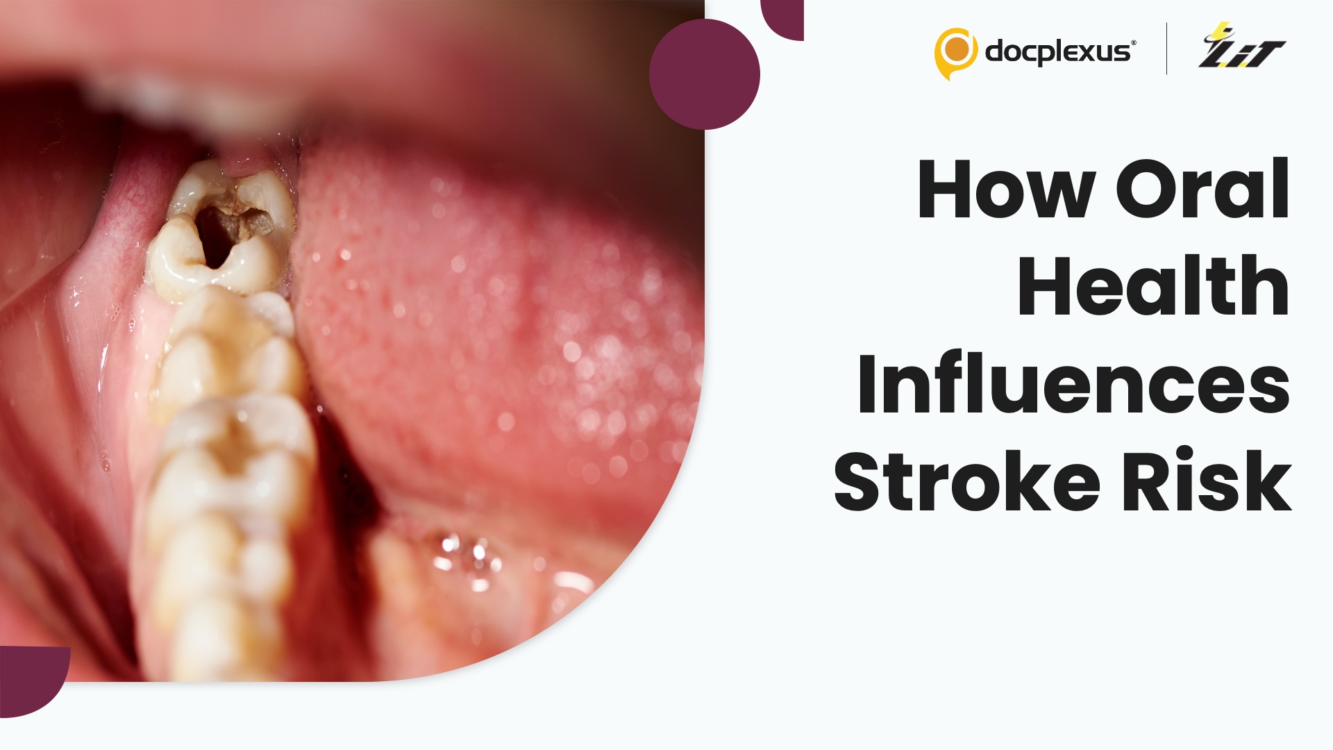 Do Periodontal Disease and Caries Raise the Risk of Stroke?