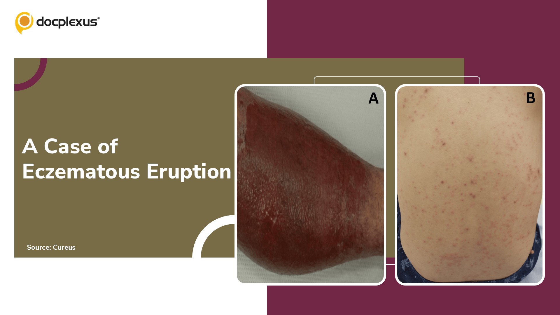 Diagnose This Rare Eczematous Reaction