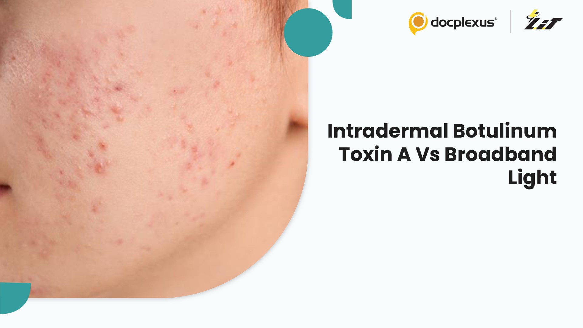 Intradermal Botulinum Toxin A Versus Broadband Light for the Treatment of Post-Acne Erythema