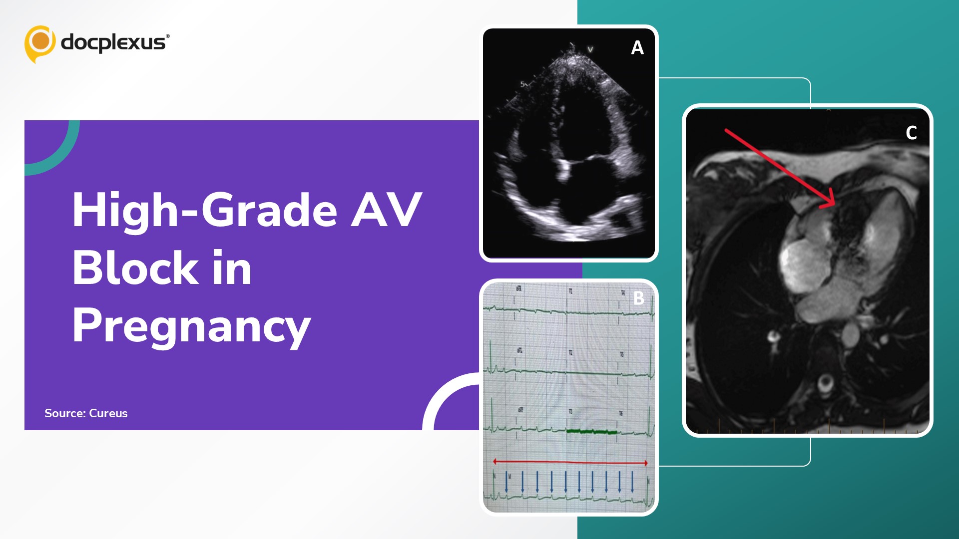 Intermittent High-Grade Atrioventricular Block and Ventricular Standstill in Late Pregnancy