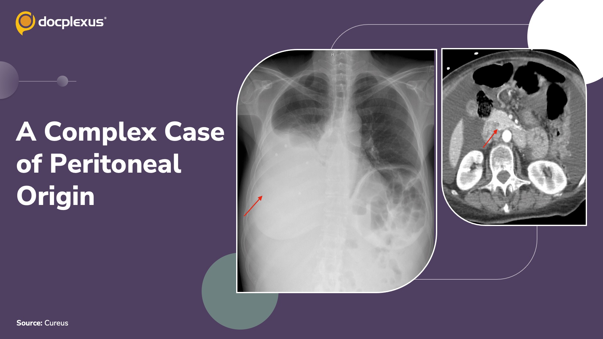 An Uncommon Peritoneal Malignancy: A Diagnostic Dilemma
