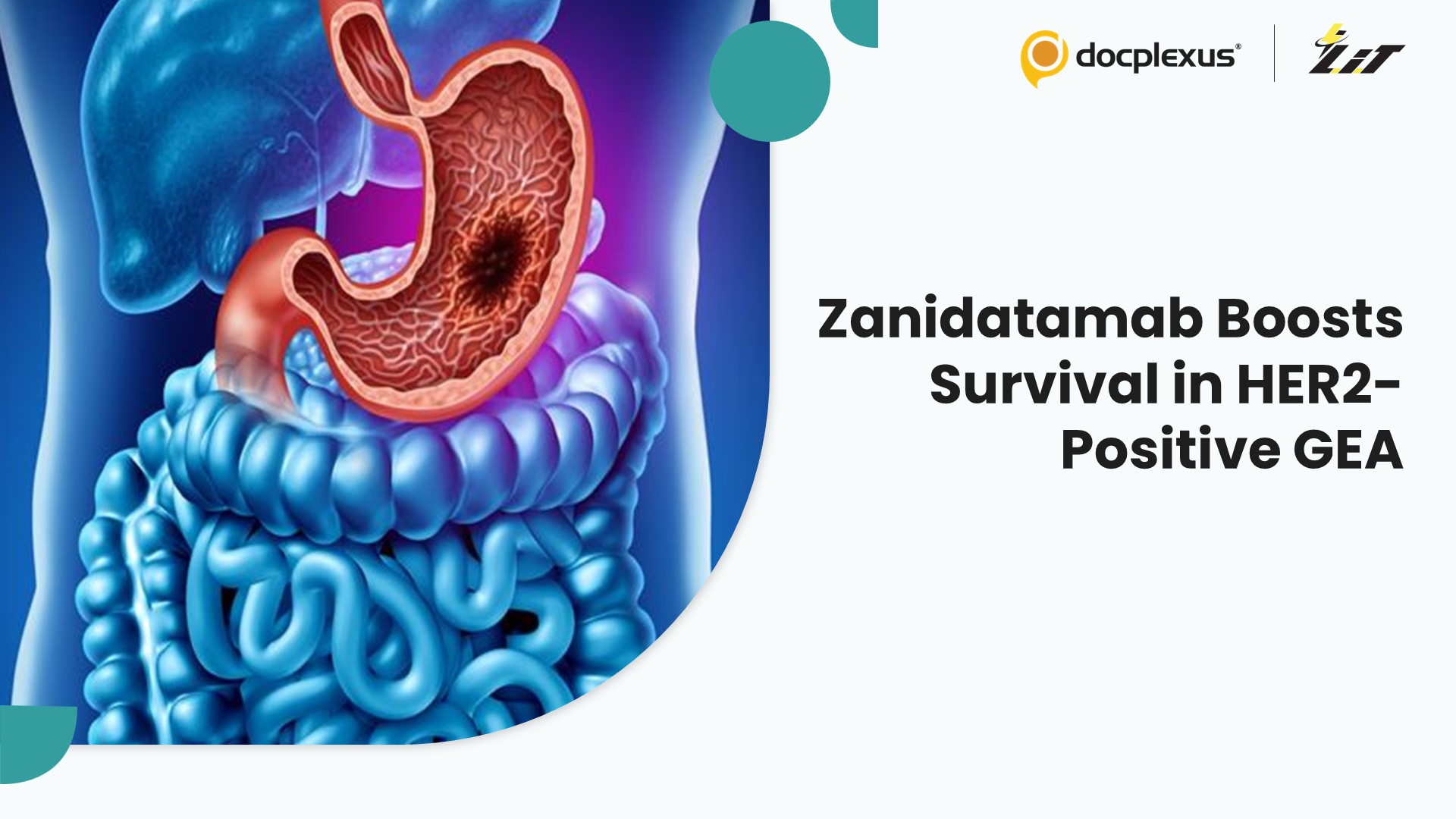 Zanidatamab Improves Survival in HER2-Positive Gastroesophageal Cancer