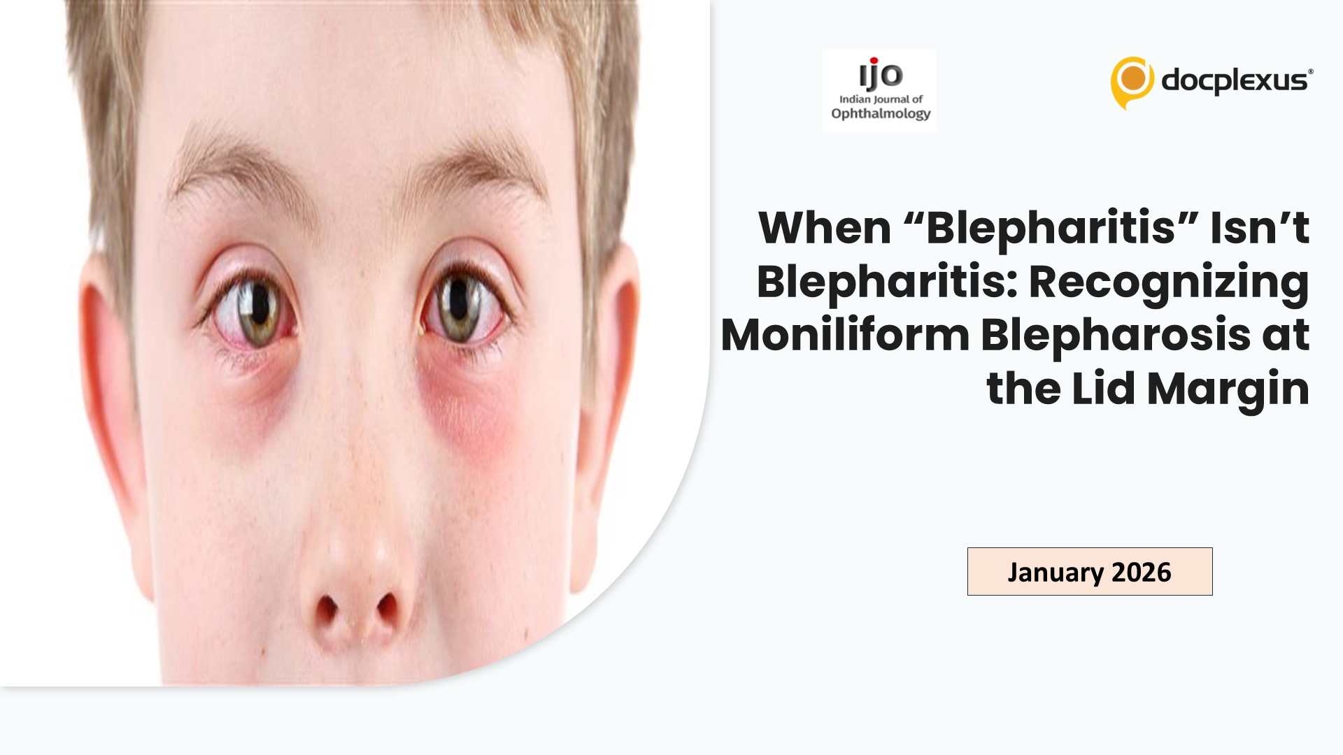 When “Blepharitis” Isn’t Blepharitis: Recognizing Moniliform Blepharosis at the Lid Margin