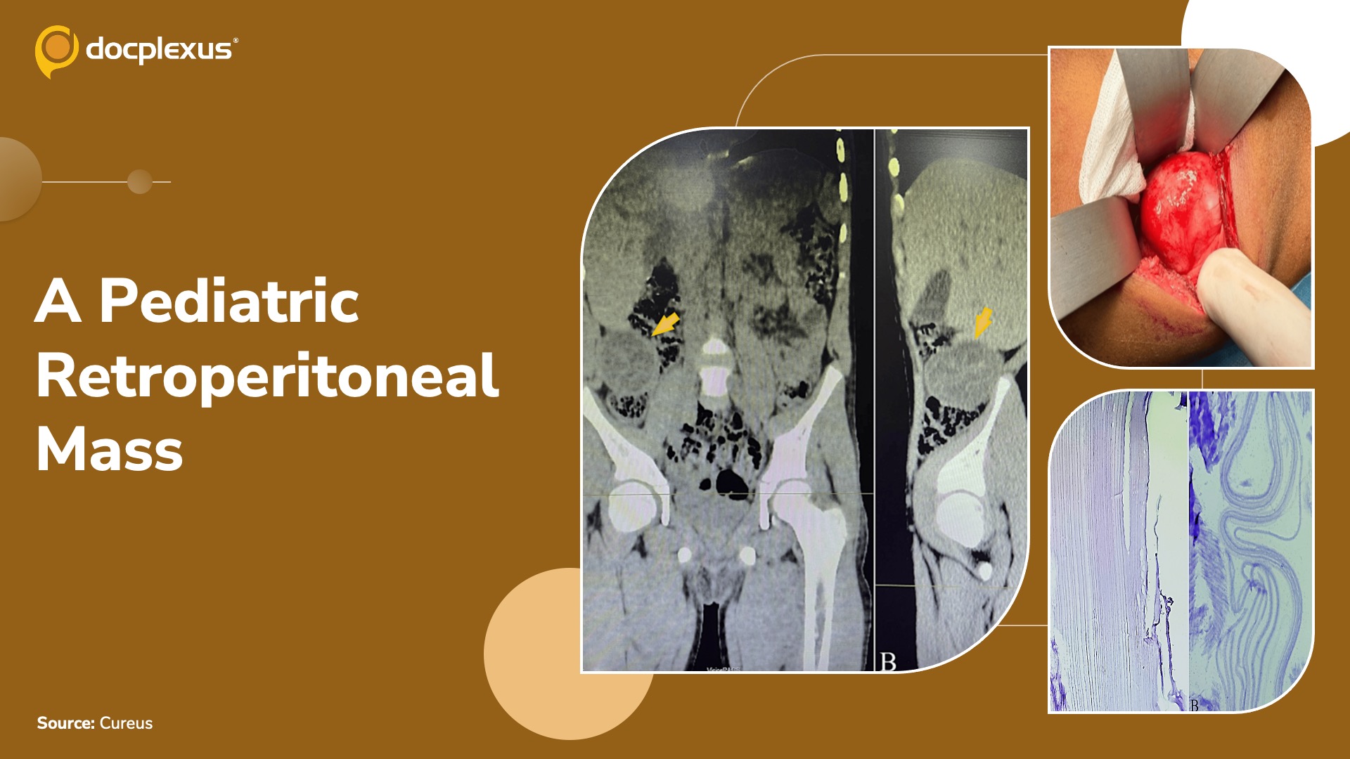 An Uncommon Presentation of a Retroperitoneal Mass