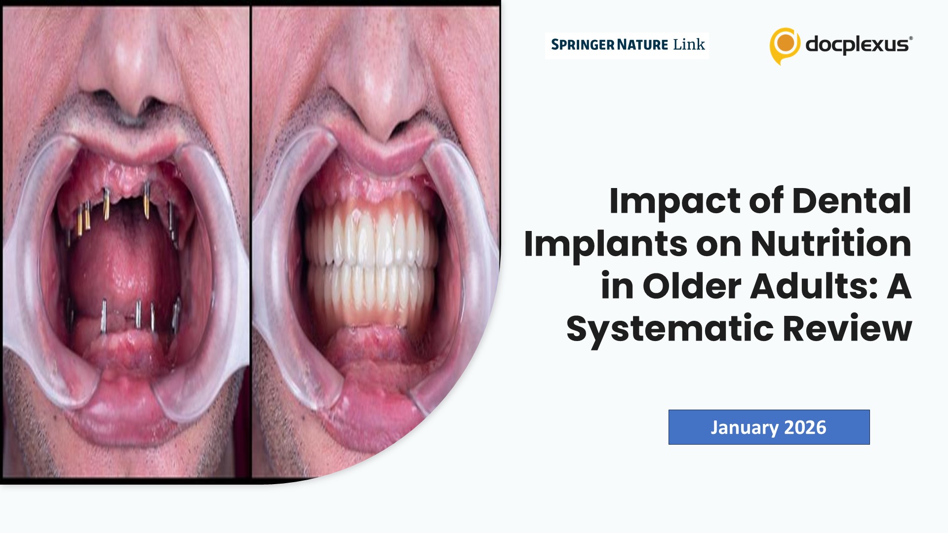 Impact of Dental Implants on Nutrition in Older Adults: A Systematic Review