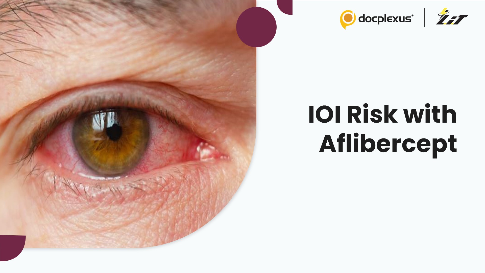 Intraocular Inflammation After Aflibercept: Real-World Insights