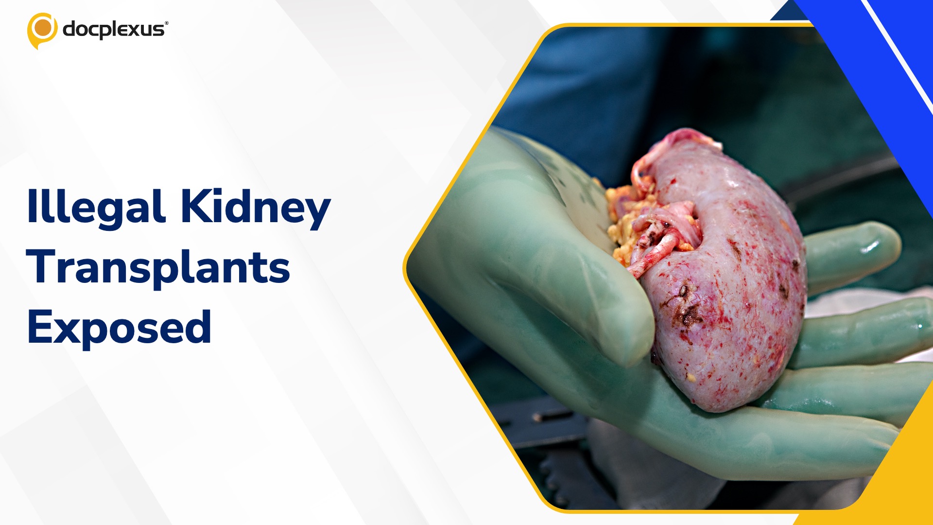 Pan-India Kidney Racket Exposed with Cambodia and China Links