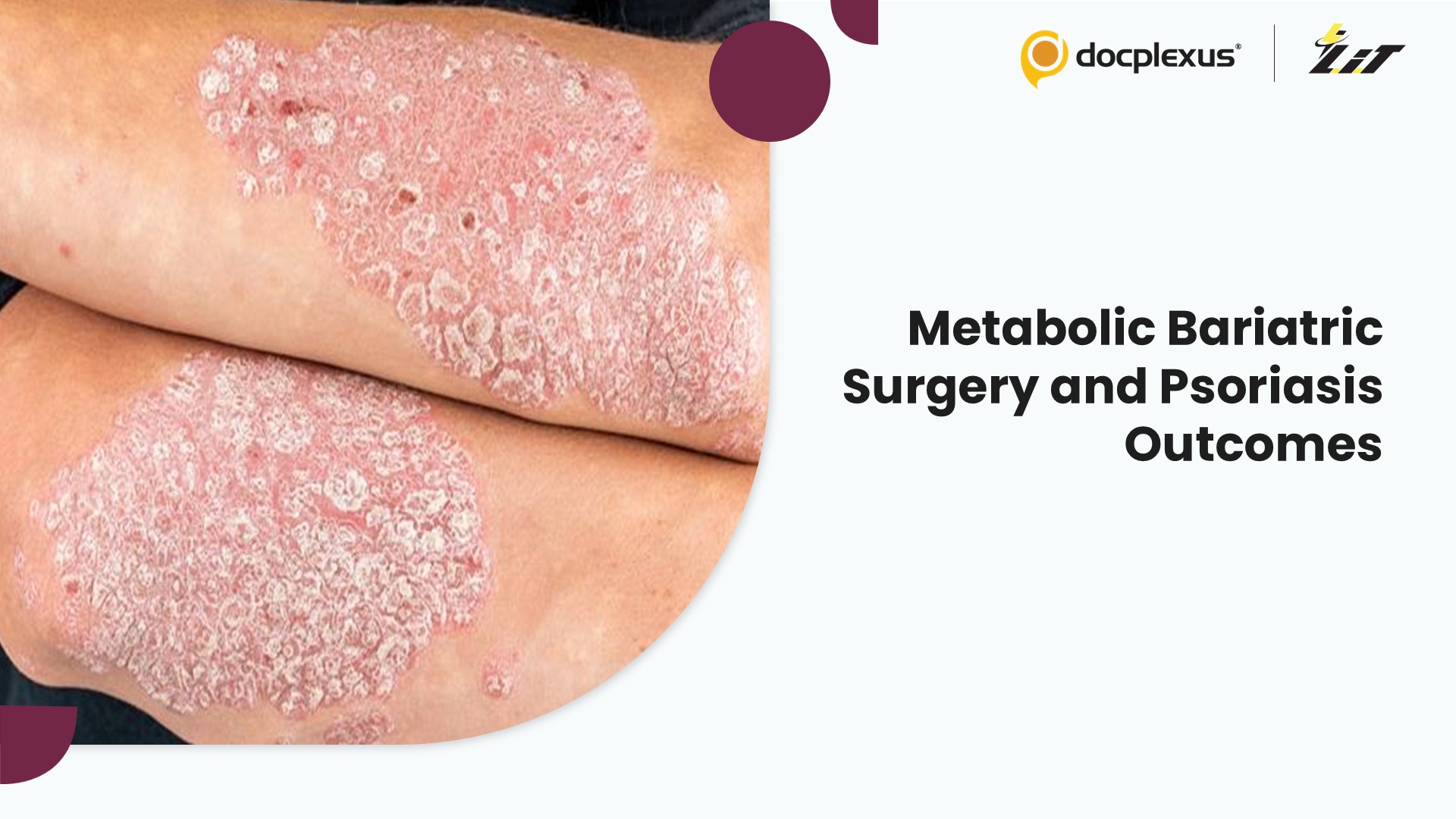 Impact of Metabolic Bariatric Surgery on Psoriasis Outcomes
