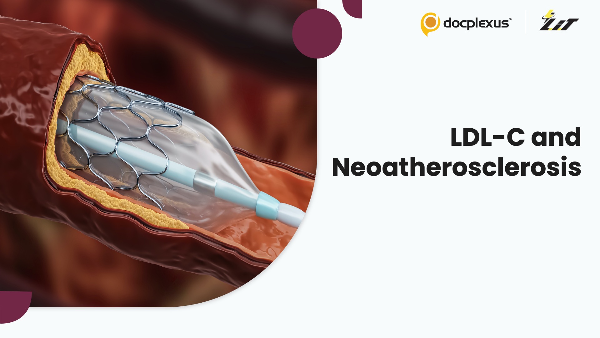Low LDL-C, Lower Risk: New Evidence on Neoatherosclerosis After DES
