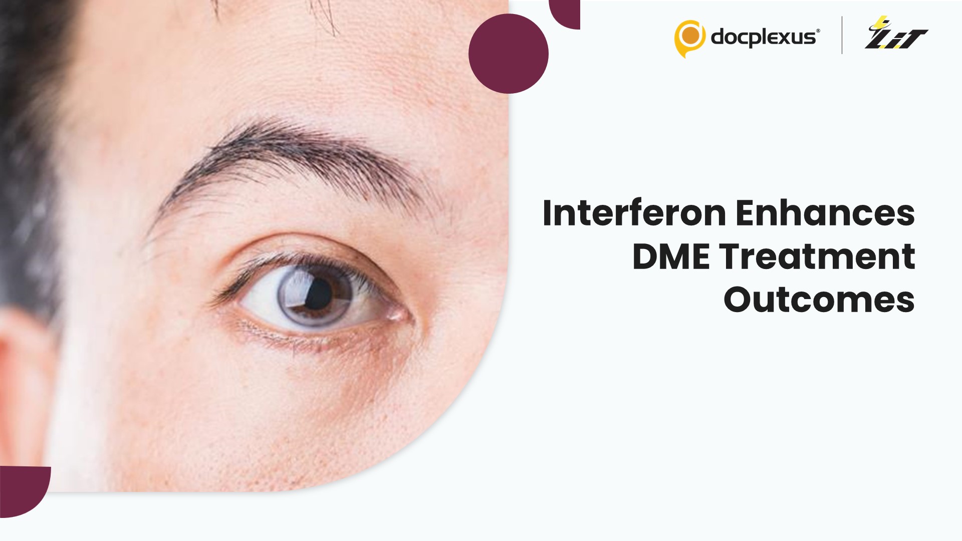 Topical Interferon Added to Bevacizumab Shows Promise in Diabetic Macular Edema