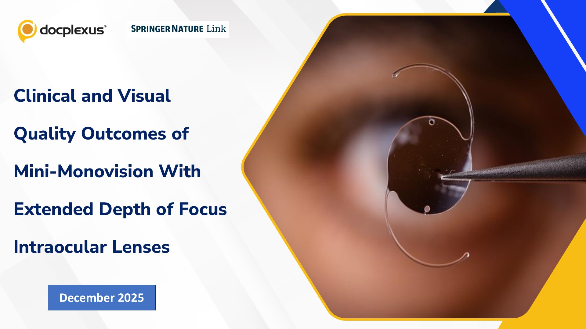 Clinical and Visual Quality Outcomes of Mini-Monovision With Extended Depth of Focus Intraocular Lenses