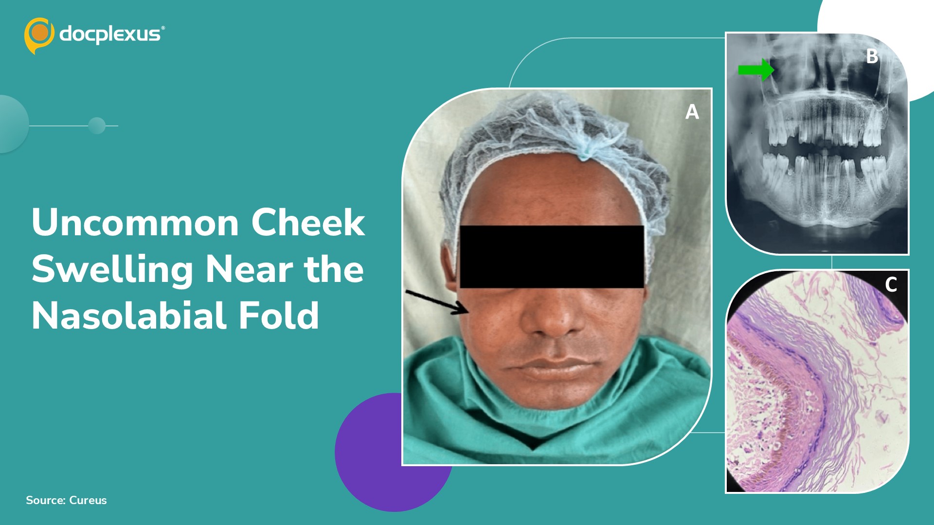 An Uncommon Nasolabial Mass: A Rare Presentation of Cheek Swelling