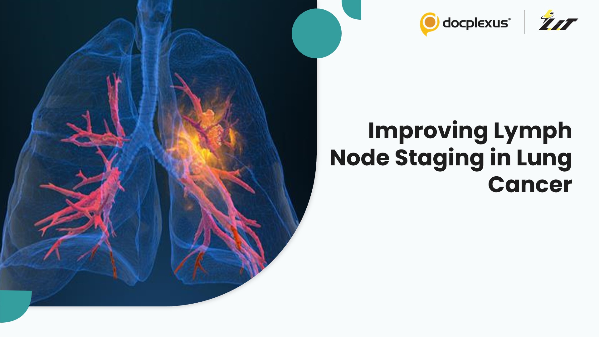 Optimizing Lymph Node Evaluation to Improve Surgical Staging in Lung Cancer