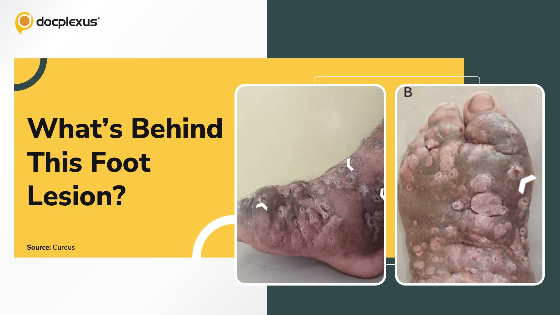A Foot That Wouldn’t Heal: Can You Crack This Chronic Case?