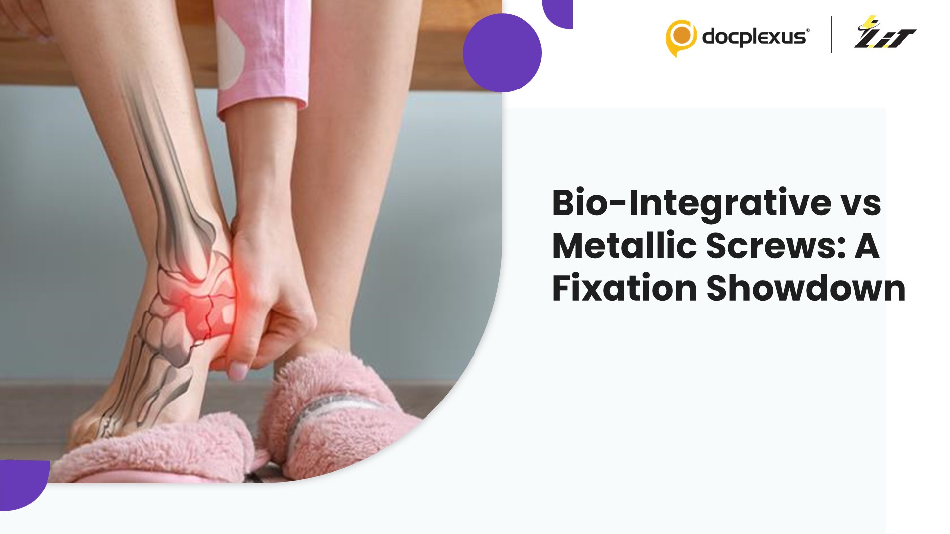 Bio-Integrative Screws vs Metallic Implants: A Turning Point in Calcaneal Osteotomy Fixation?