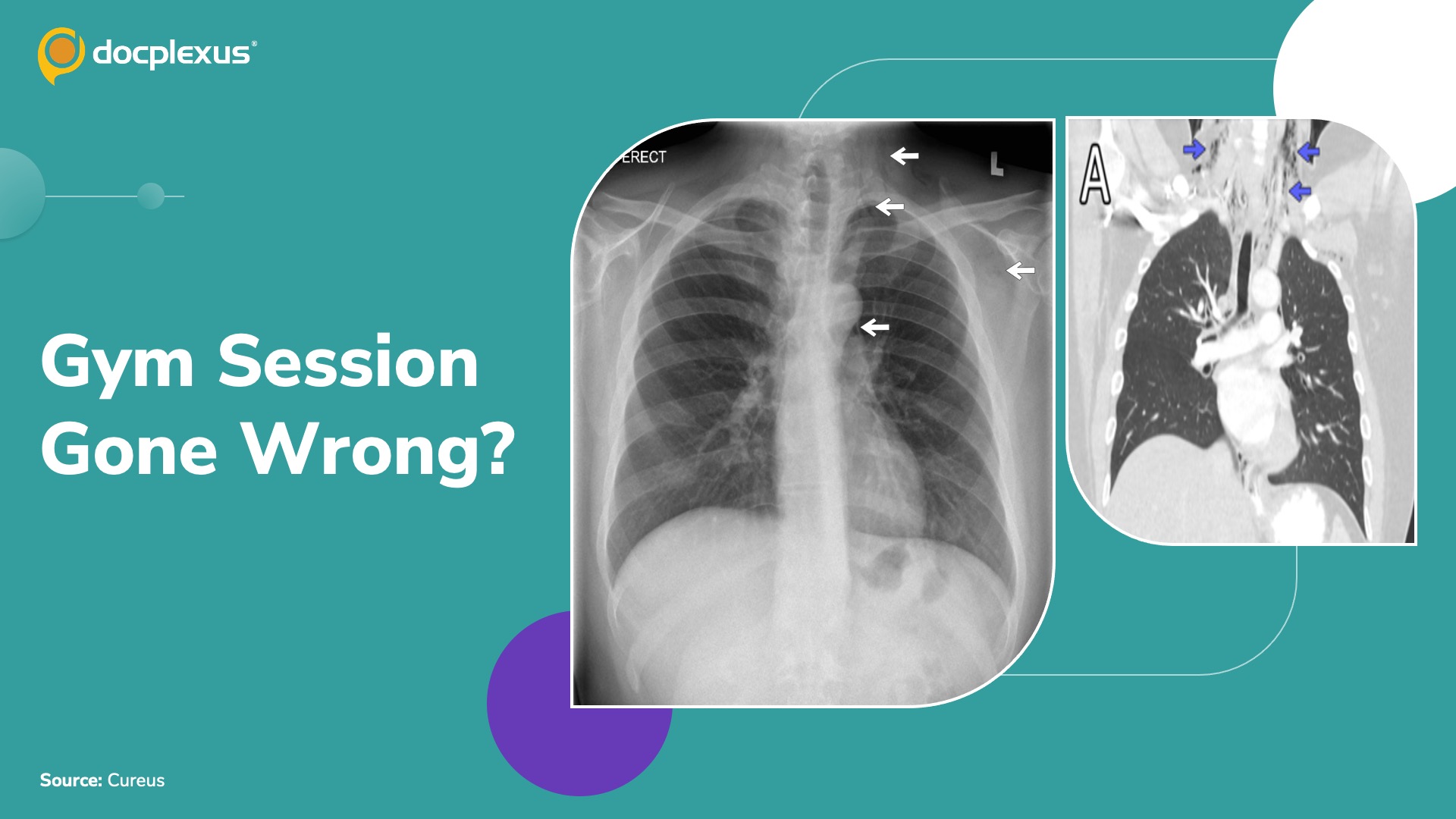 Sudden Throat Pain After Heavy Lifting — What’s the Diagnosis?