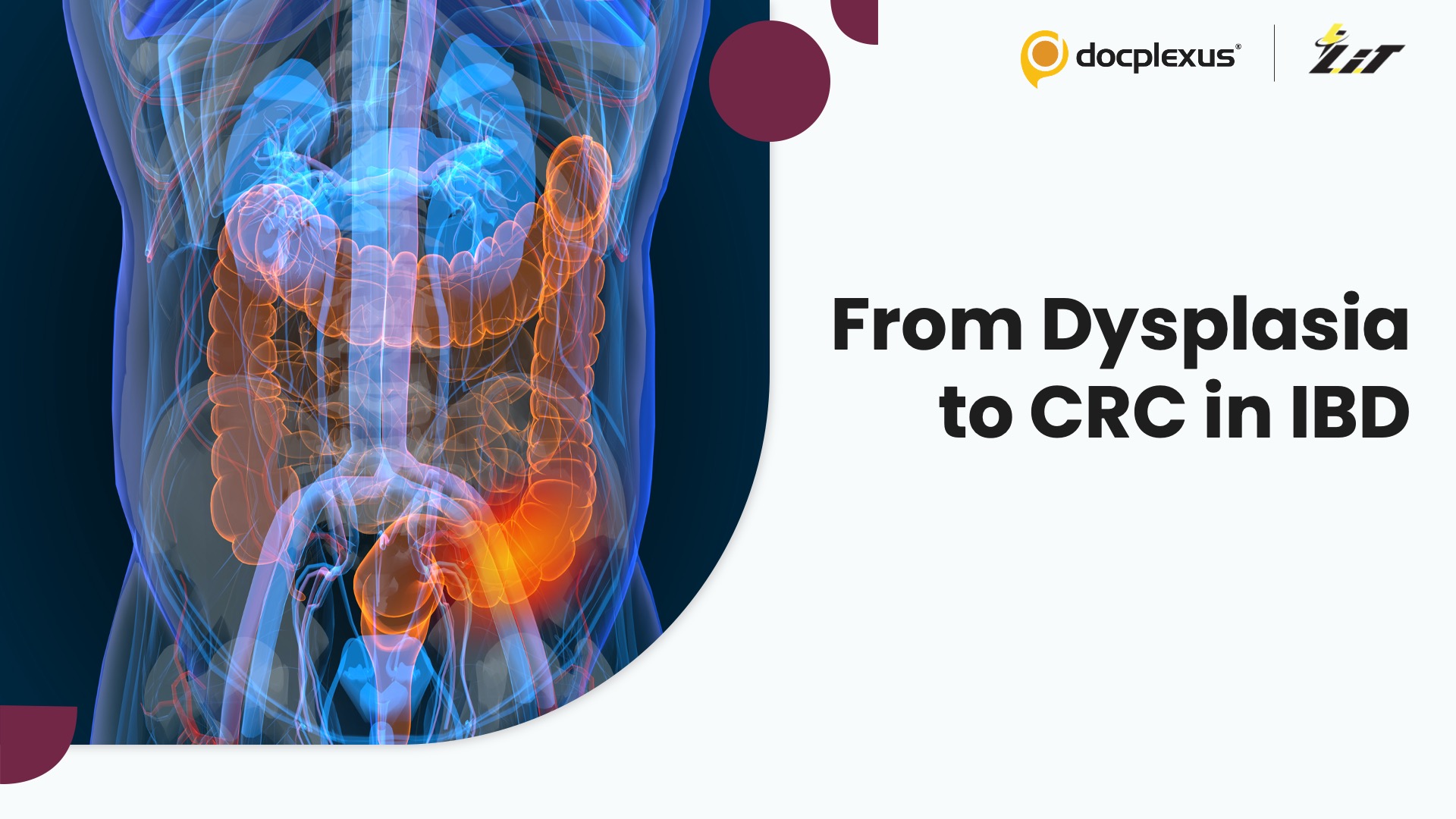 From Dysplasia to Colorectal Cancer: Measuring Risk in IBD