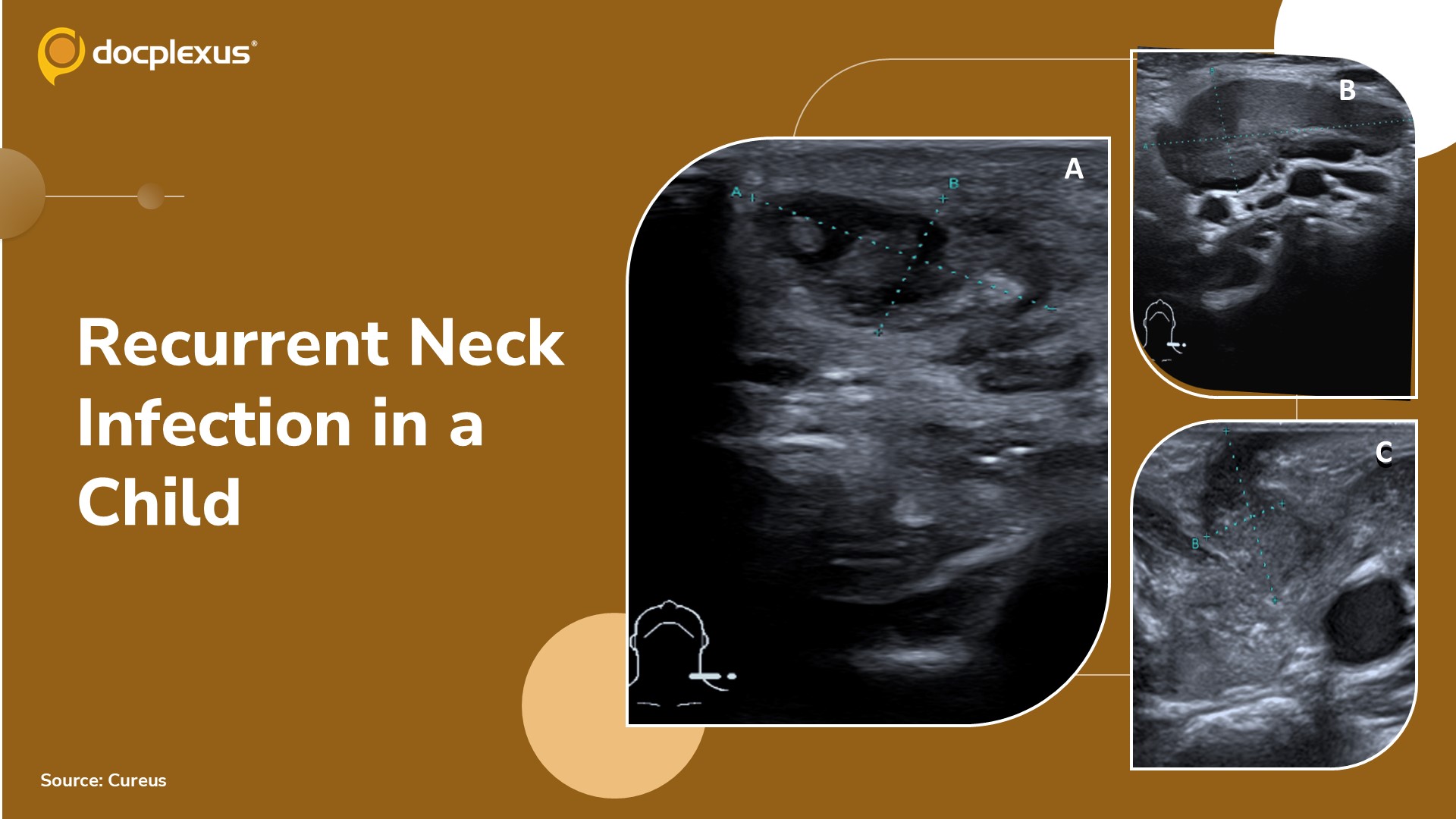 Recurrent Cervical Infection in a Pediatric Patient: Diagnostic and Management Considerations