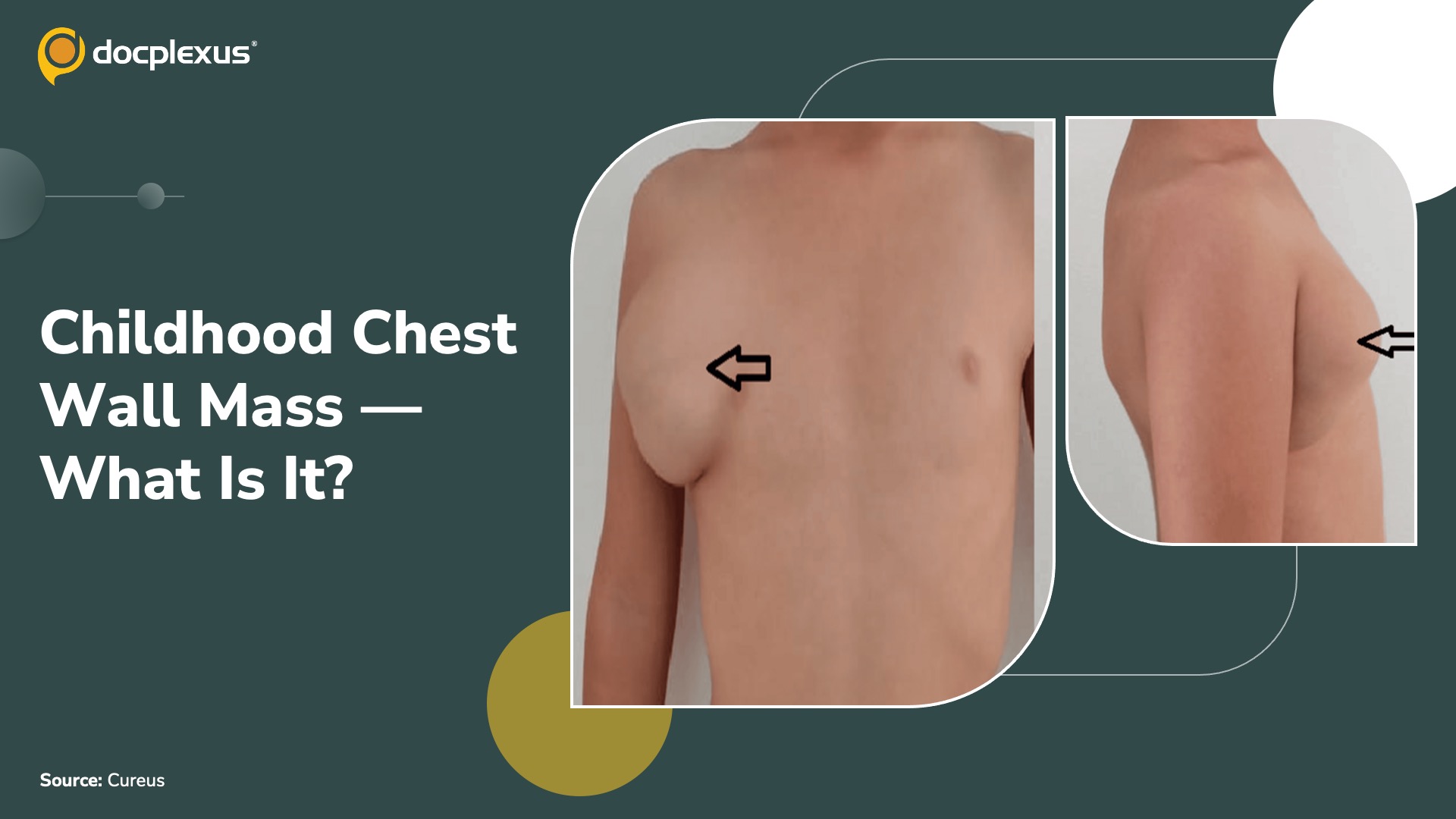 A Growing Chest Wall Mass in a 5-Year-Old: Can You Solve This Case?