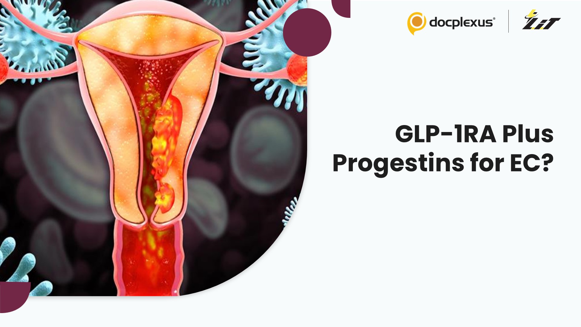 Can GLP-1RA Combined with Progestins Redefine Endometrial Cancer Prevention?