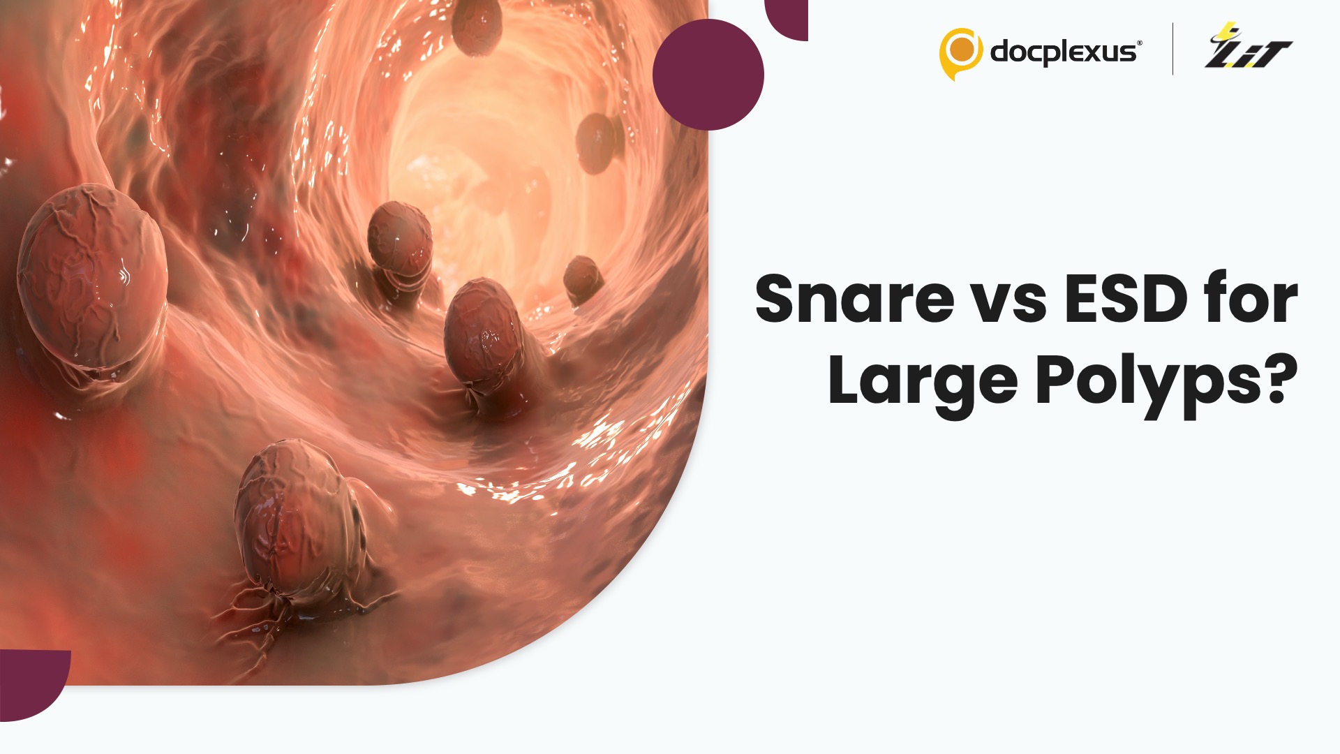 Snare-Tip or ESD Knife: Does Tool Choice Matter in Precutting Endoscopic Mucosal Resection?