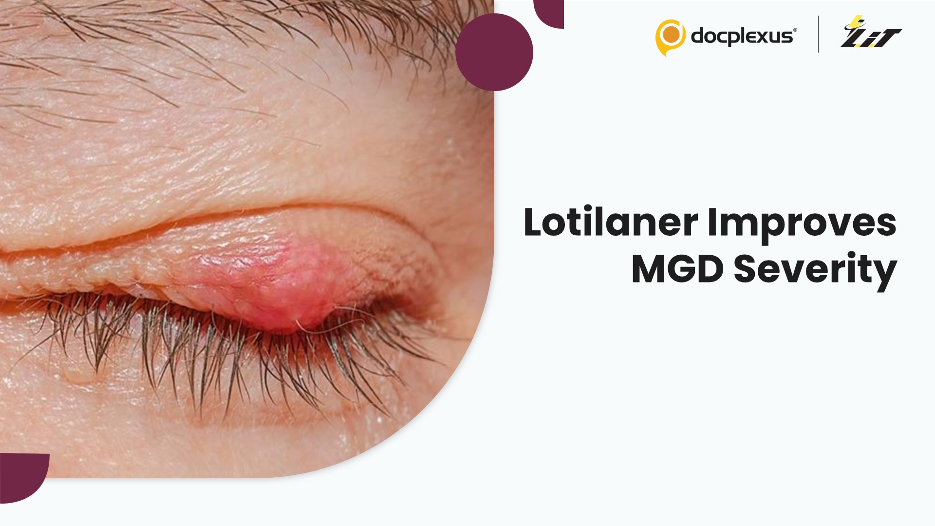 Targeting Demodex: Lotilaner for Meibomian Gland Disease Improvement