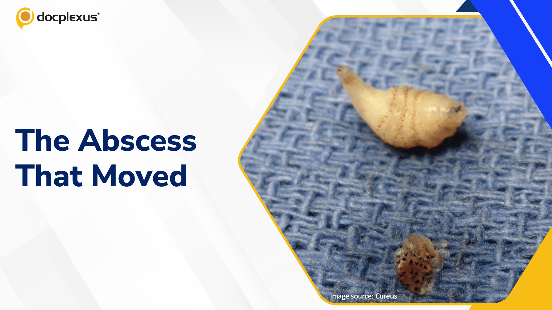 When “Abscesses” Crawl: A Child’s Hidden Botfly Infection
