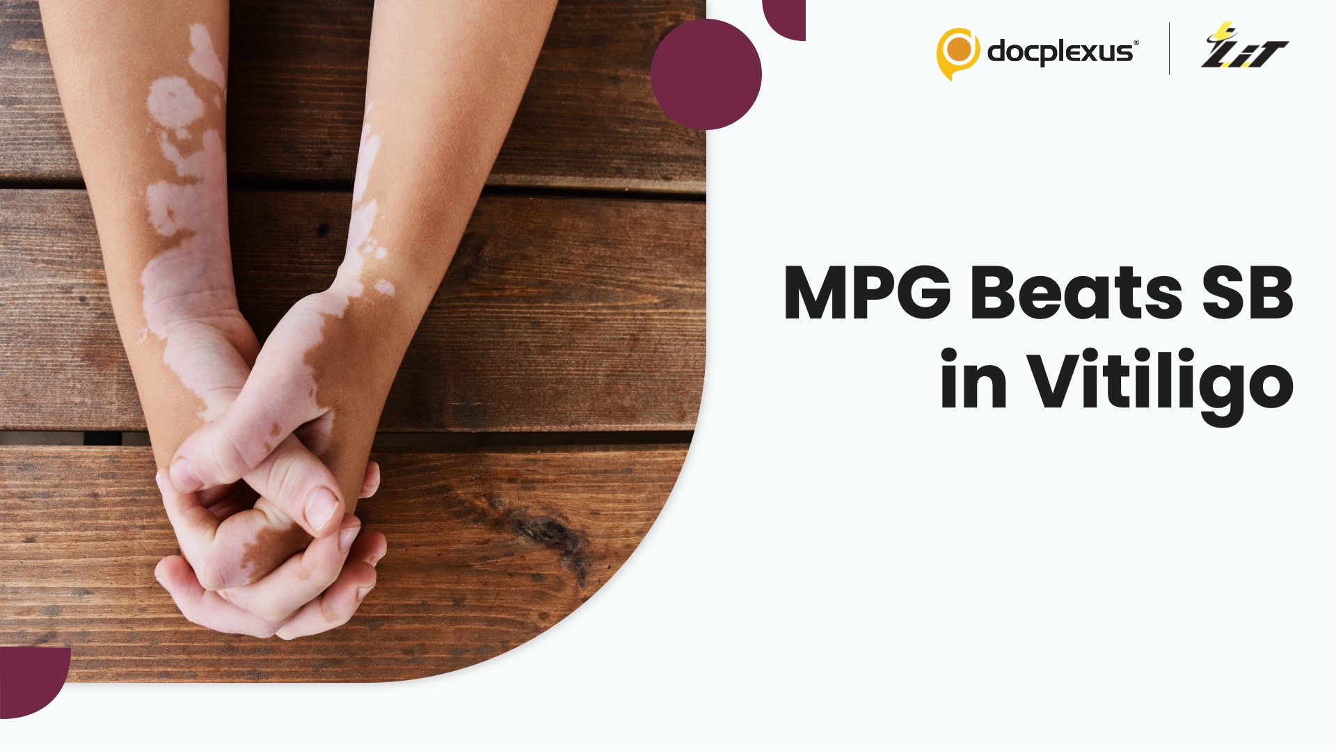 Micro Punch Grafting Outperforms Suction Blistering in Stable Vitiligo