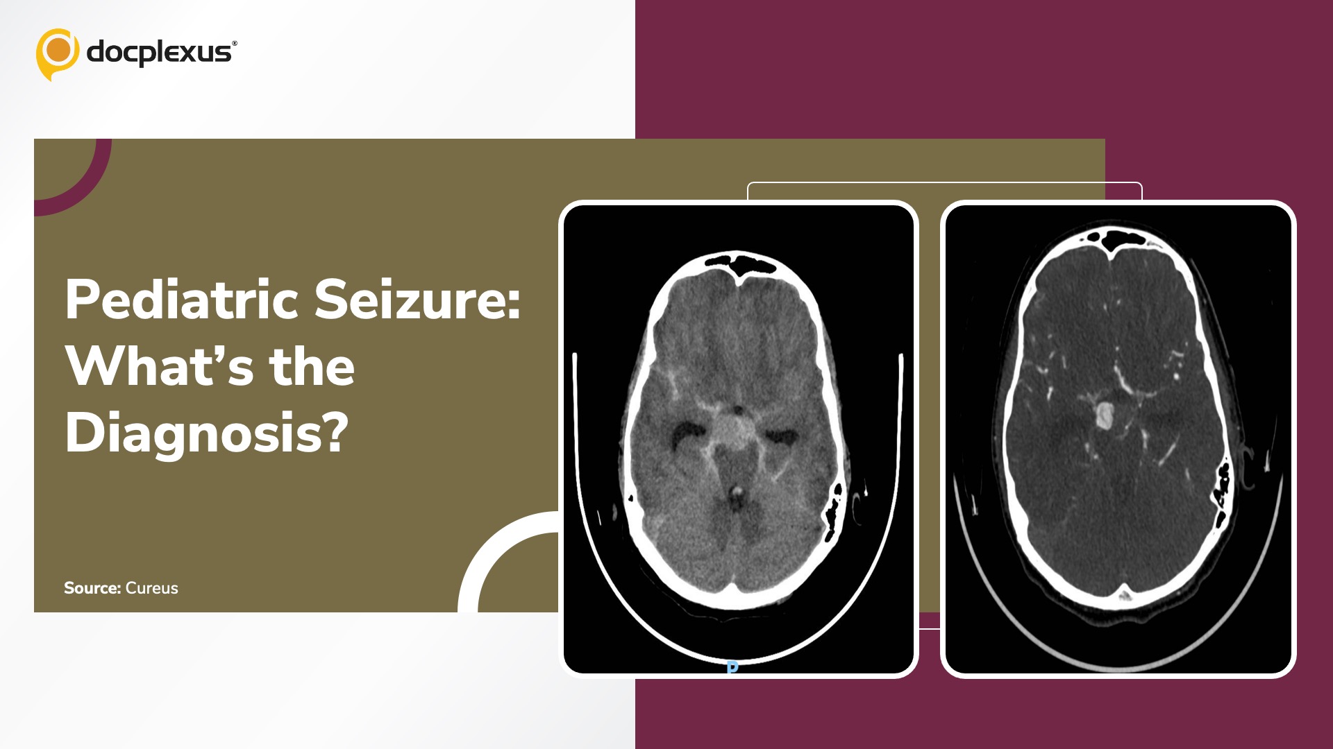 Seizure After a Week of Headache: Can You Spot the Diagnosis?
