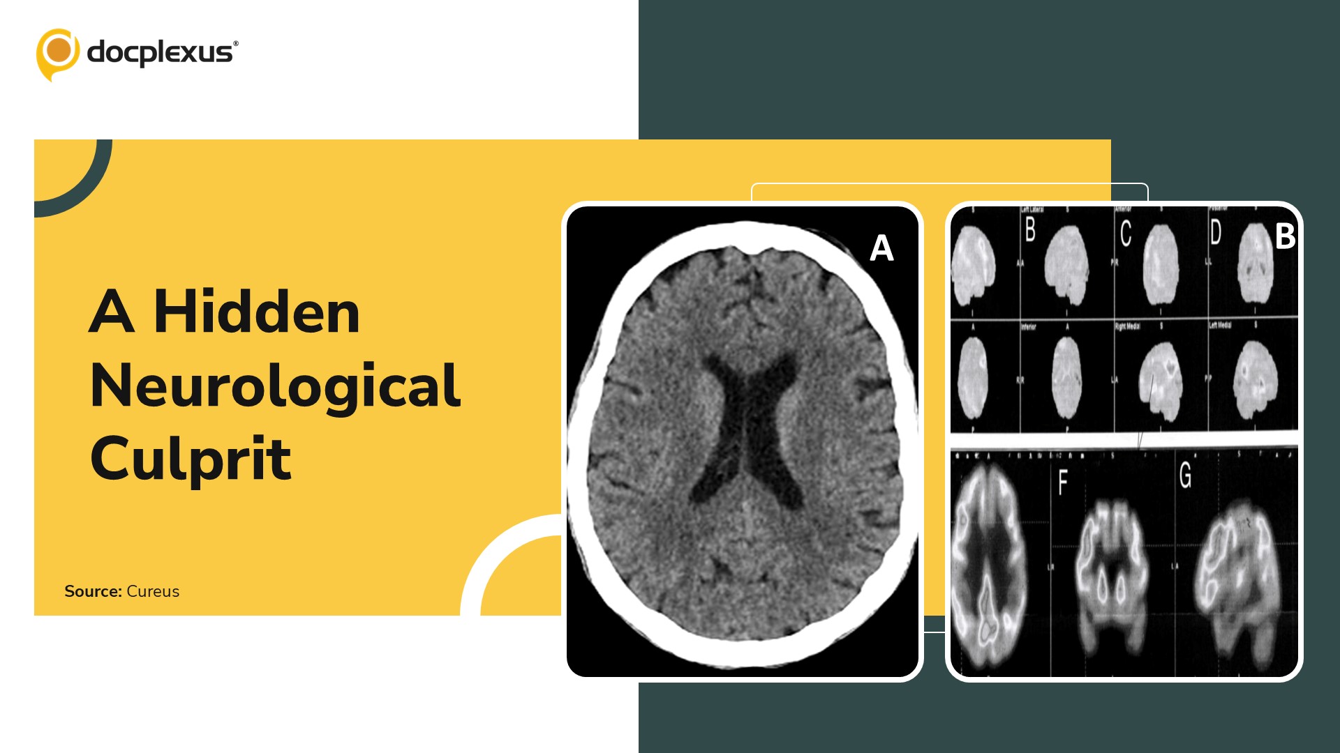 Psychiatric Symptoms or Neurological Disease? A Diagnostic Dilemma