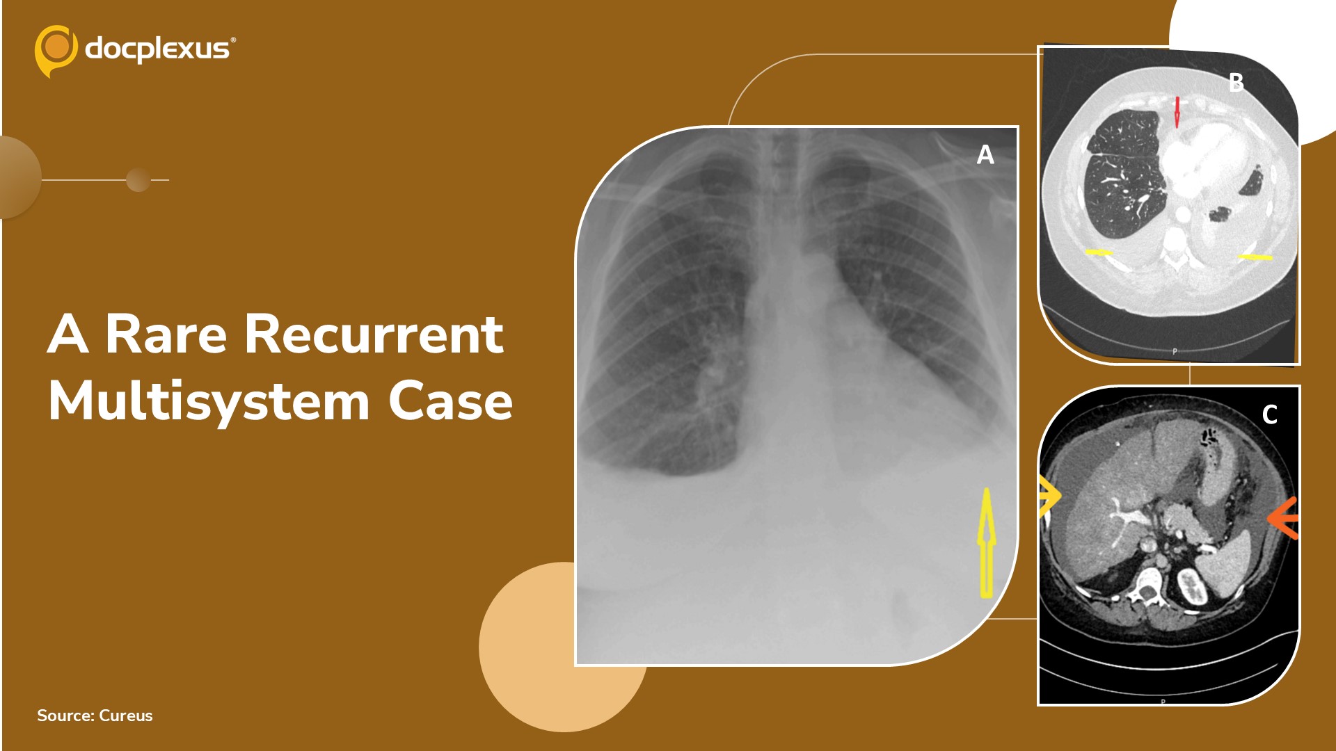 A Case of Recurrent Multisystem Symptoms: A Diagnostic Challenge