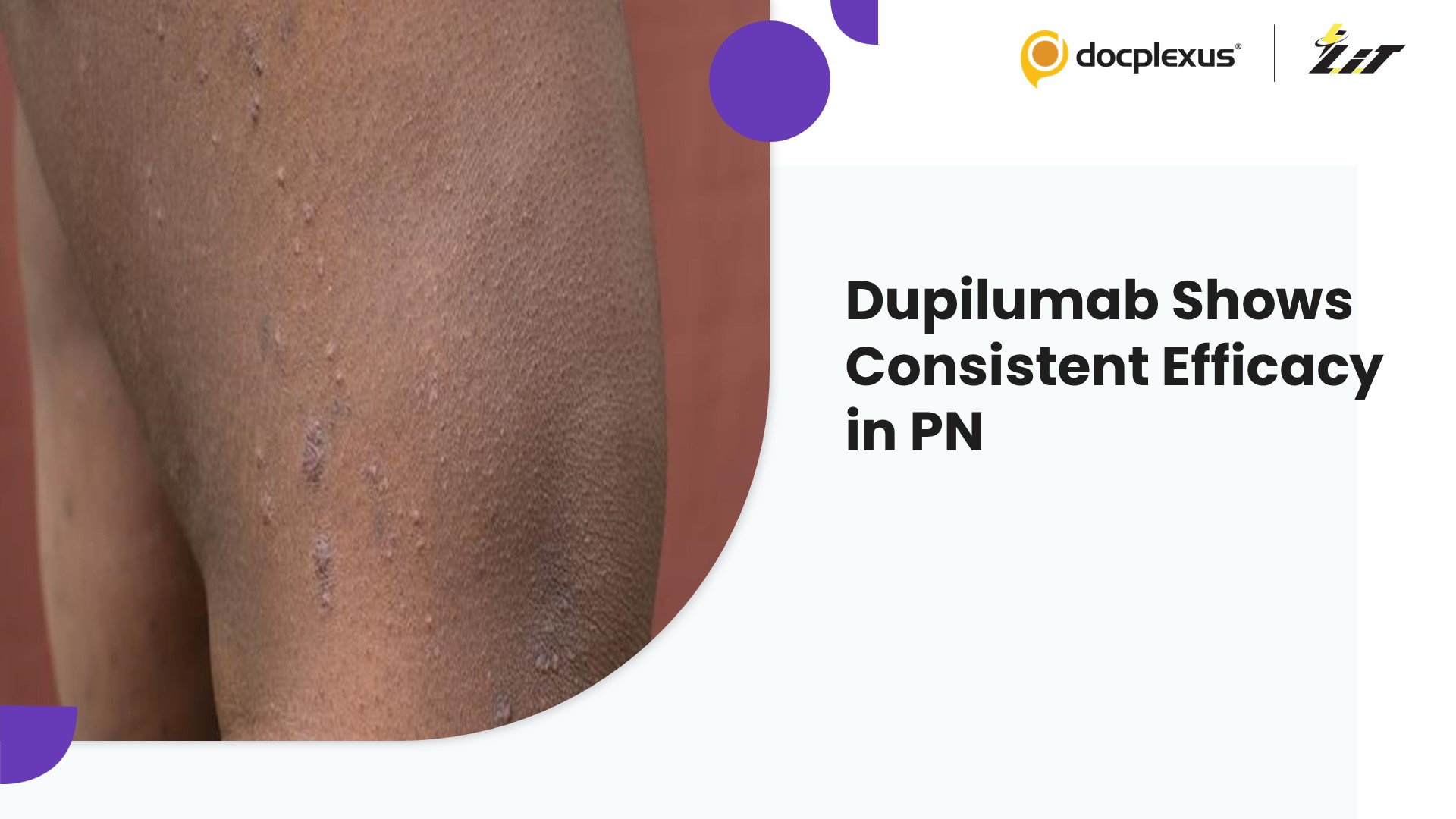Beyond Atopy: Dupilumab Shows Comparable Benefits in All PN Patients