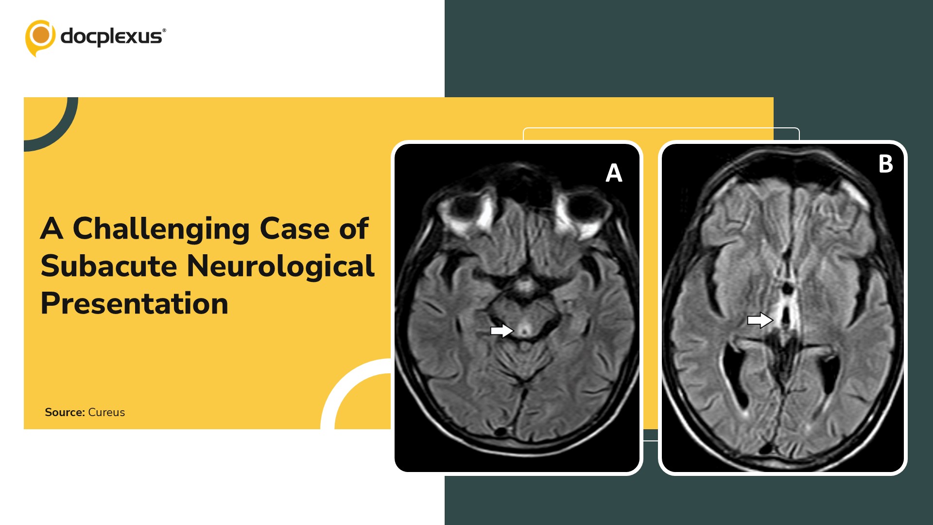 A Diagnostic Challenge of Subacute Neurological Symptoms in Nutritional Deficiency