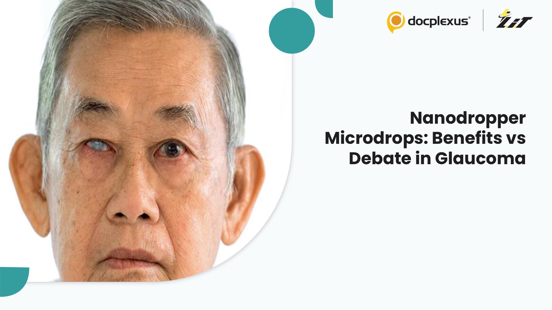 Nanodropper Microdrops in Glaucoma: Improved Efficiency Amid Ongoing Debate