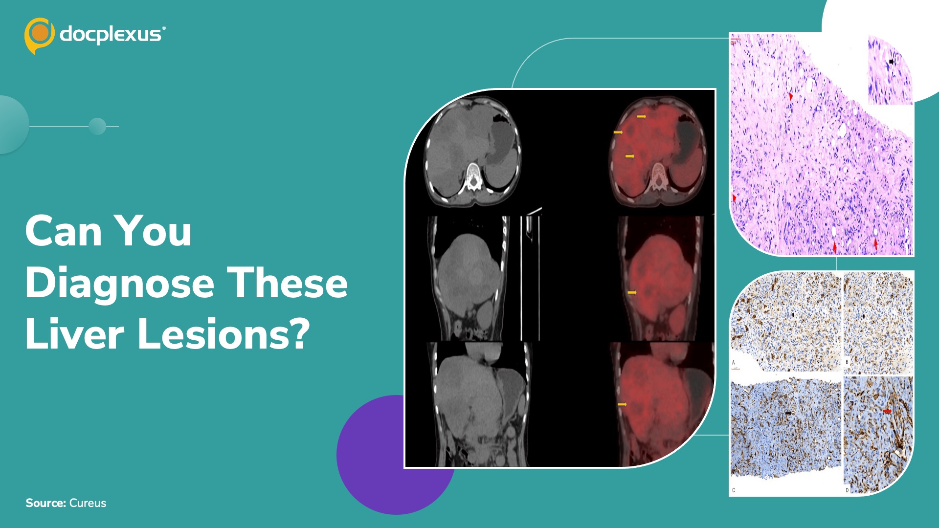 When Multifocal Hepatic Lesions Mimic Metastatic Carcinoma: A Diagnostic Challenge