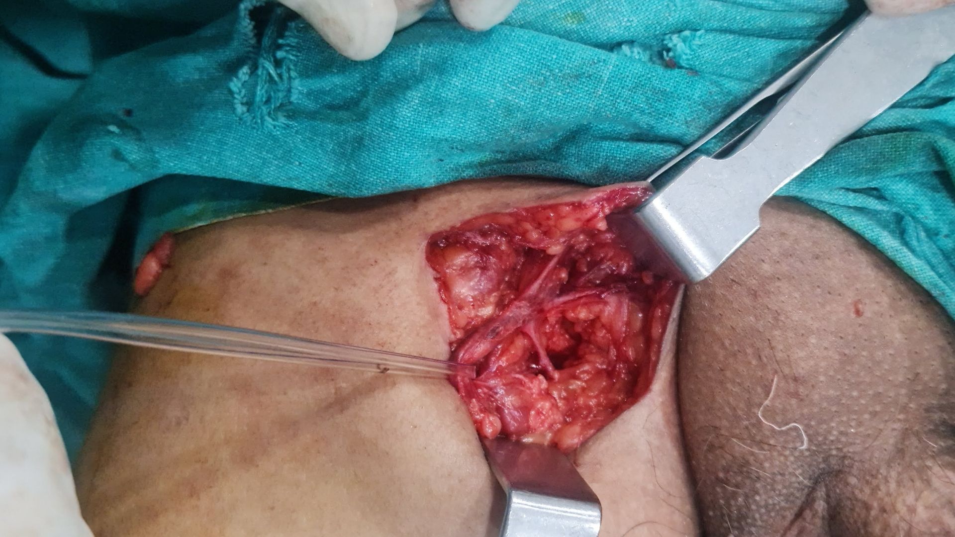 Saphenofemoral Junction Ligation with GSV Stripping in a Symptomatic Middle-Aged Male: A Case Experience