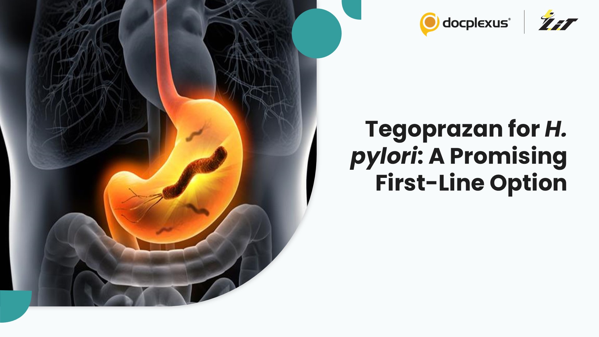 Tegoprazan vs Lansoprazole: A New First-Line Approach for H. pylori Eradication