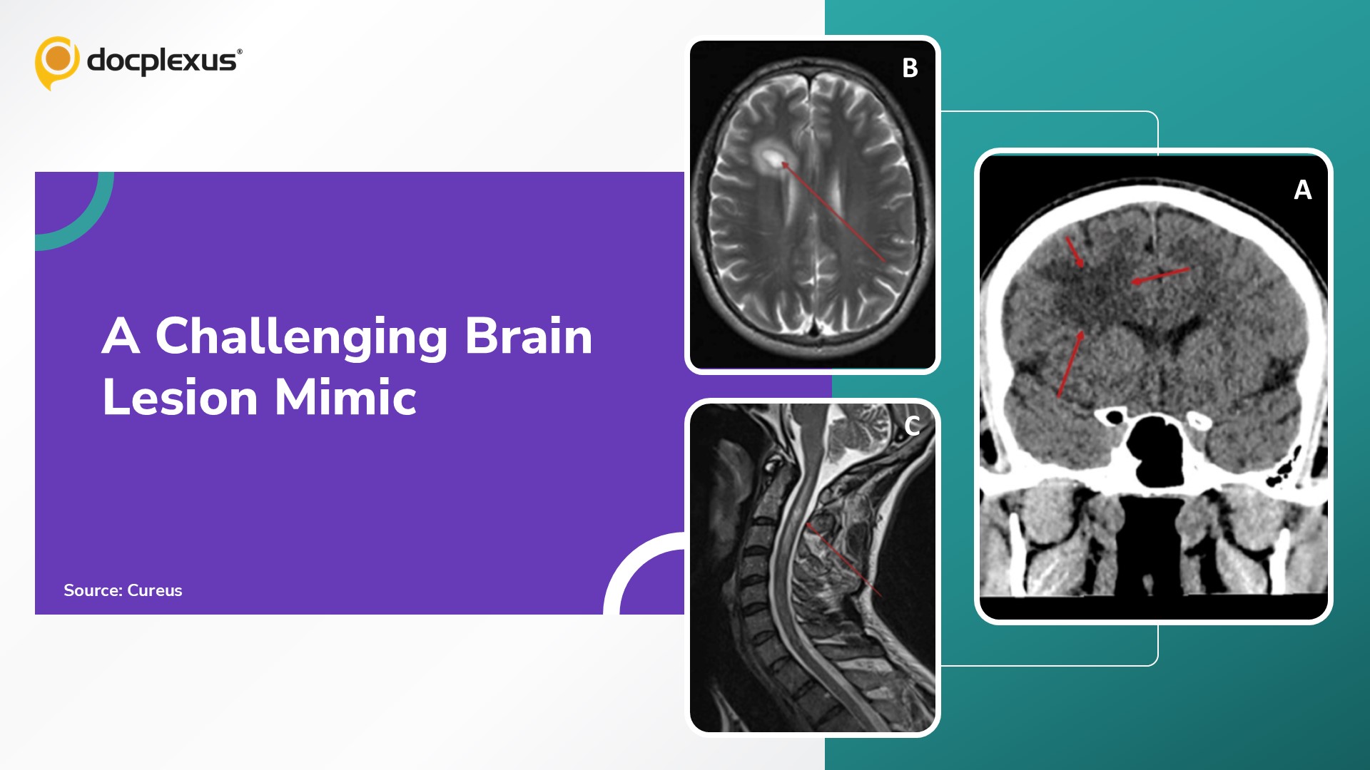 A Neurological Diagnosis Mimicking a Brain Tumor