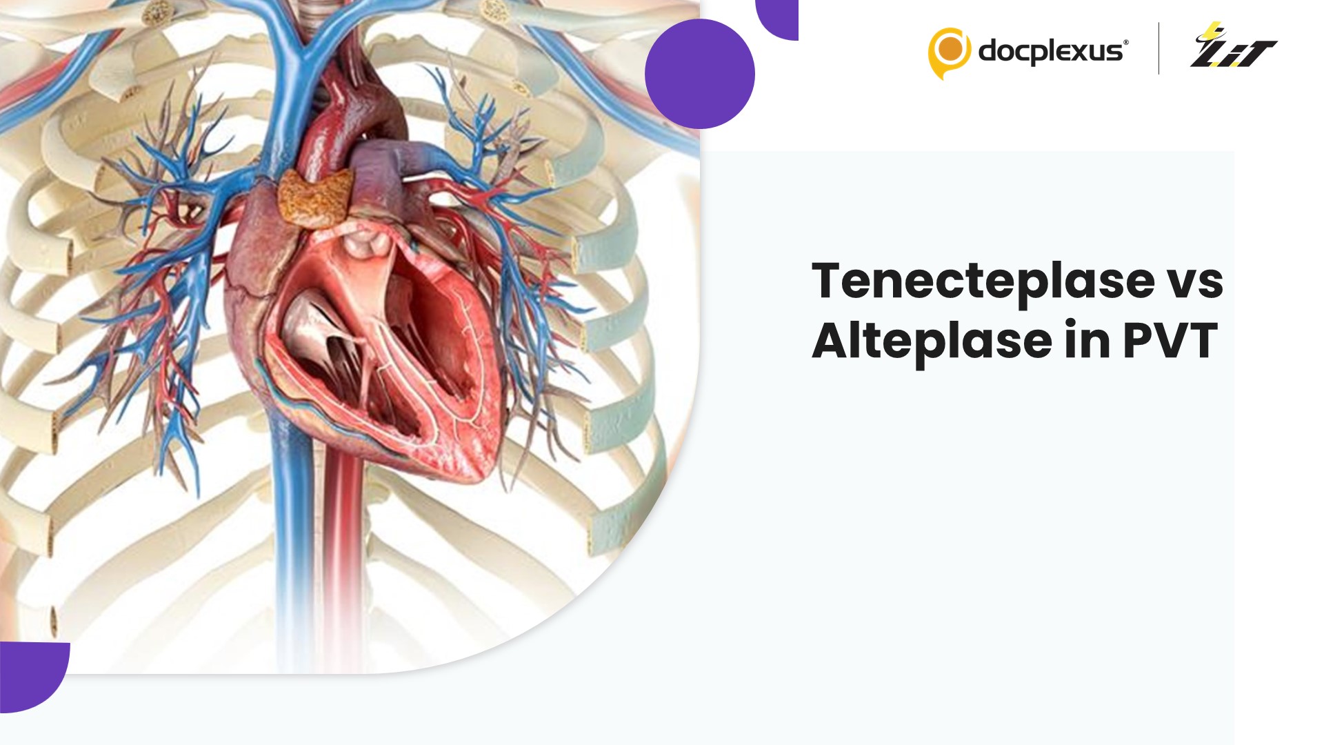 Tenecteplase vs Alteplase in Prosthetic Valve Thrombosis: A Comparative Study