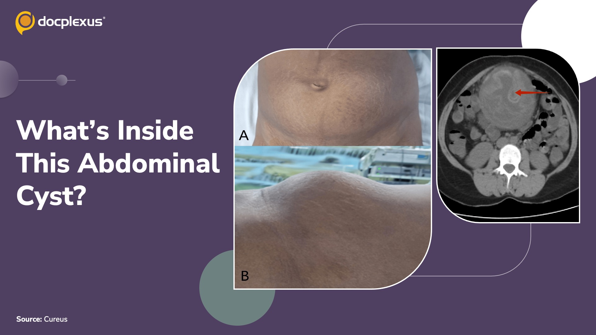 Nine Months of Abdominal Swelling After LSCS: A Surgical Mystery
