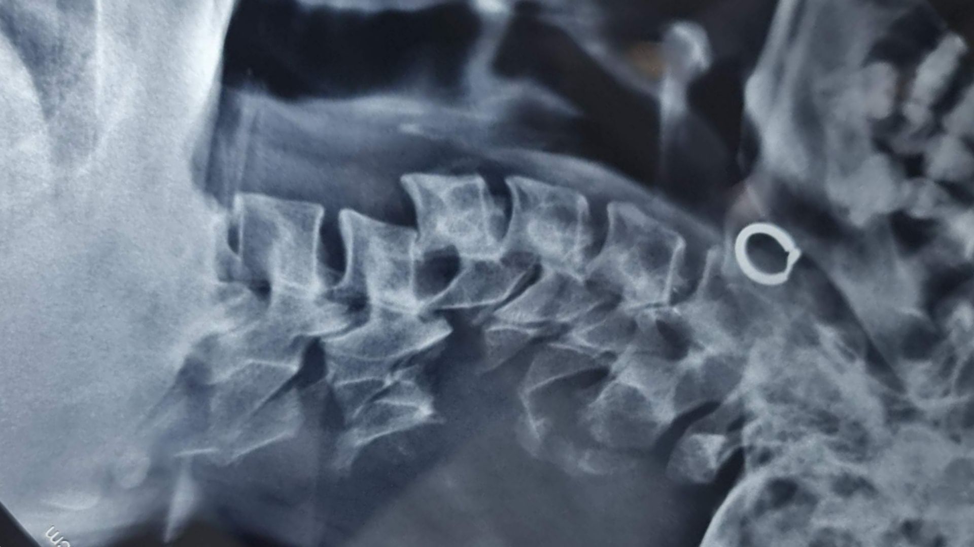 Clinicoradiological Dissociation: A Walking Patient with Severe Cervical Spine Injury