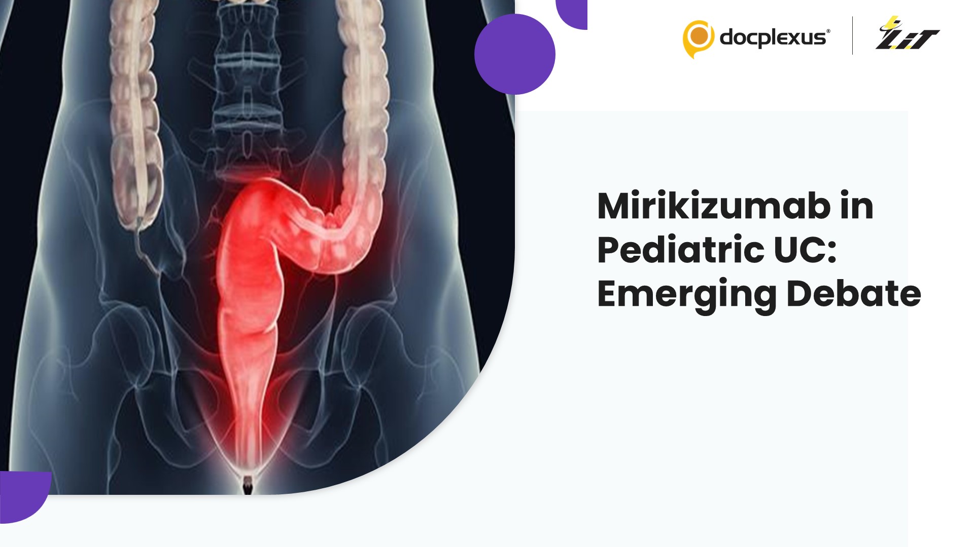 Mirikizumab in Pediatric Ulcerative Colitis: A Promising Yet Debated Therapy