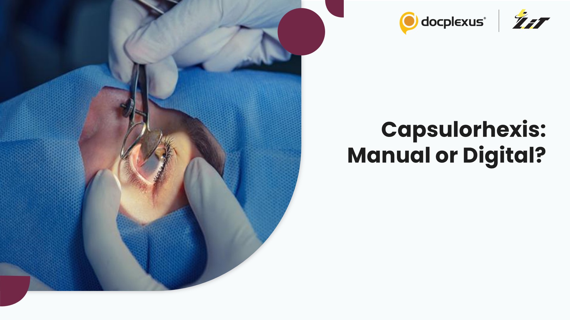Manual vs Digital Capsulorhexis in Cataract Surgery