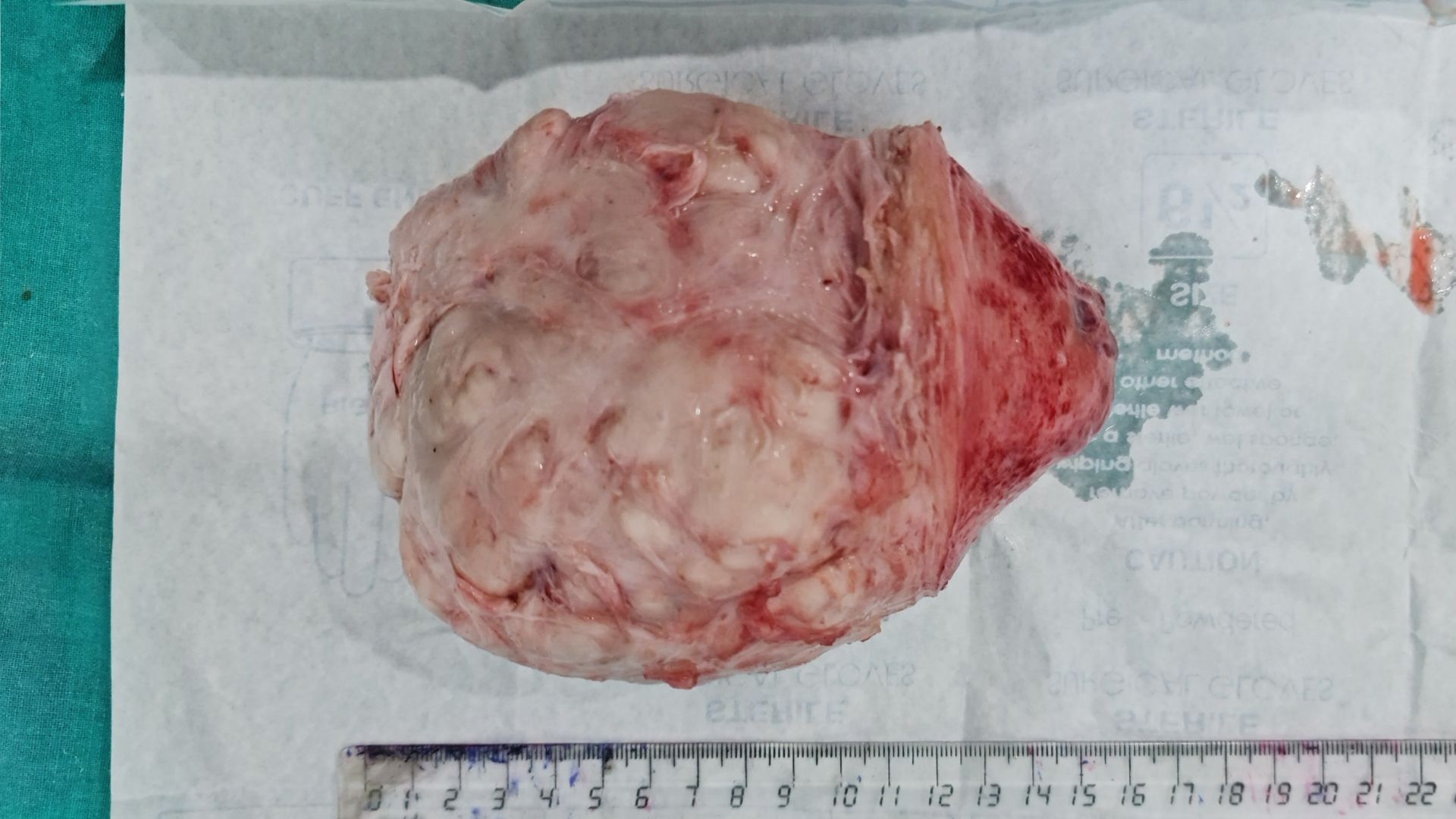 When Innovation Meets Simplicity: Foley Catheter for Bloodless Myomectomy
