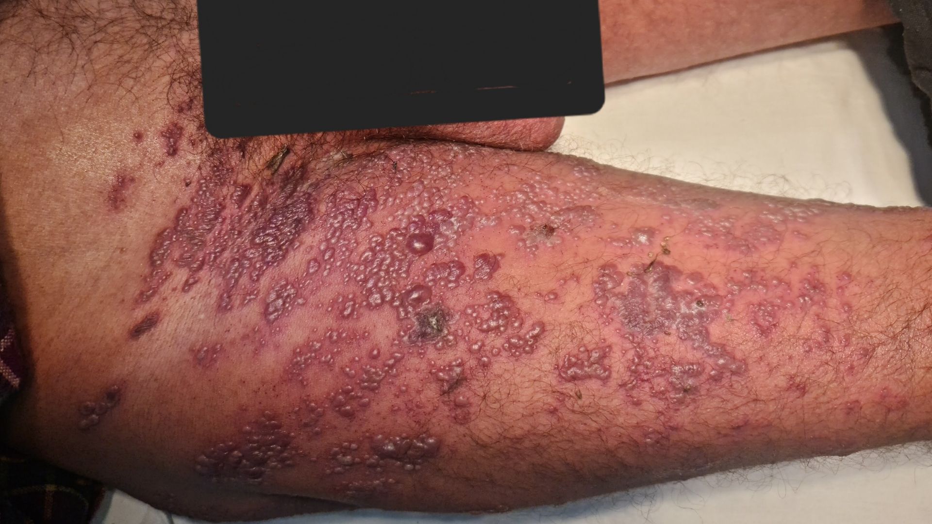 Spot Diagnosis: Fever with Painful Vesicular Rash