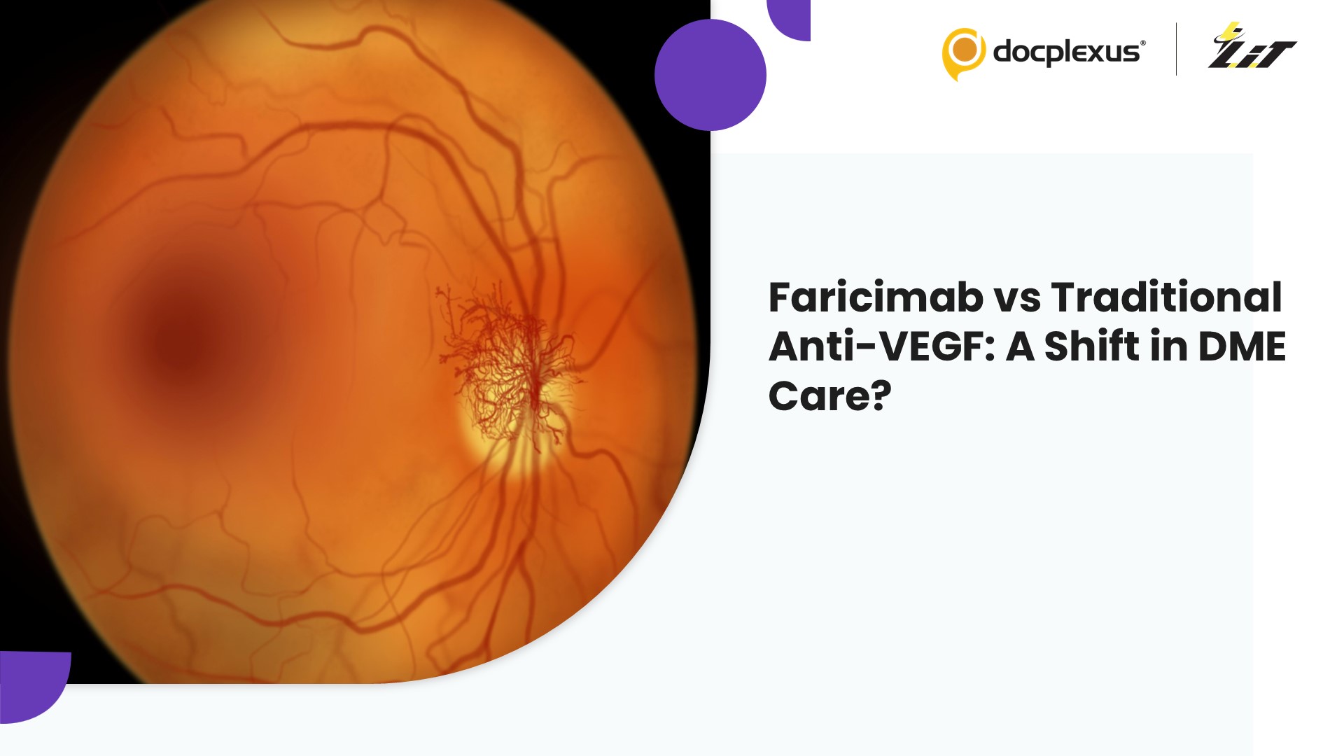Faricimab in DME: A Real-World Game Changer or Just Another Anti-VEGF?