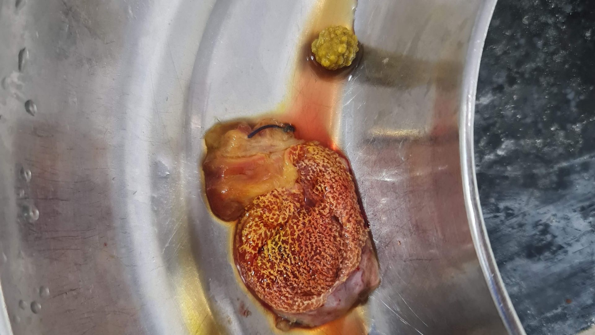 When the Gallbladder Turns Strawberry: A Classic Case of Cholesterolosis