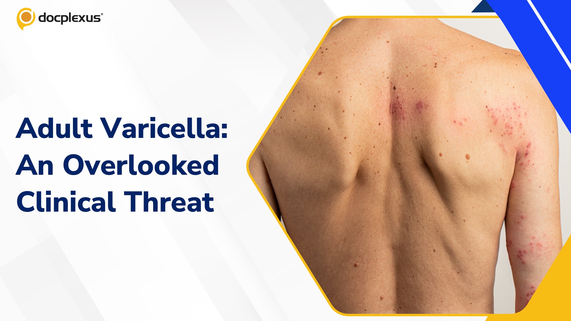 Adult Varicella: Clinical Severity, Pulmonary Complications, and the Importance of Early Intervention